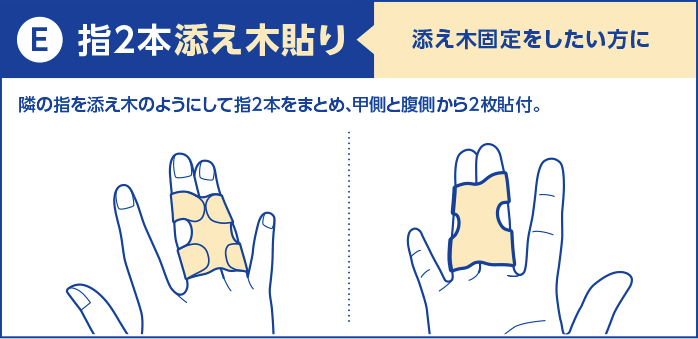 e)指2本添え木貼り：添え木固定をしたい方に。隣の指を添え木のようにして指2本をまとめ、甲側と腹側から2枚貼付。