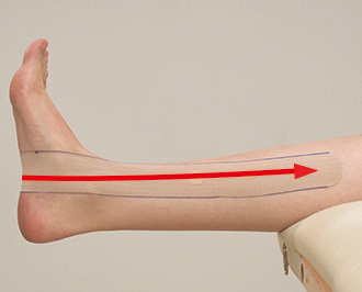 脛 すね シンスプリントのテーピング 下腿内側の脛骨の下方の痛み テーピング 巻き方 バトルウィン