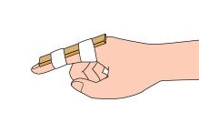 処置 突き指 応急 小指を突き指して痛い時の応急処置や固定の仕方を説明します