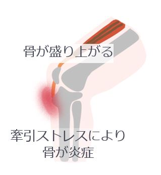 骨が盛り上がる 牽引ストレスにより骨が炎症